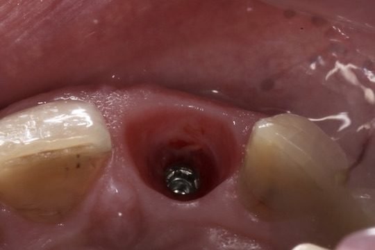 Hammasimplantin paranemisvaihe: implantti asetettuna poistetun hampaan tilalle