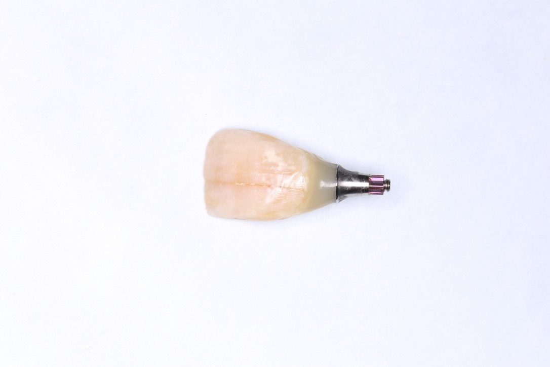 Implanttikruunu yksilöllisellä jatkeella ennen kiinnitystä