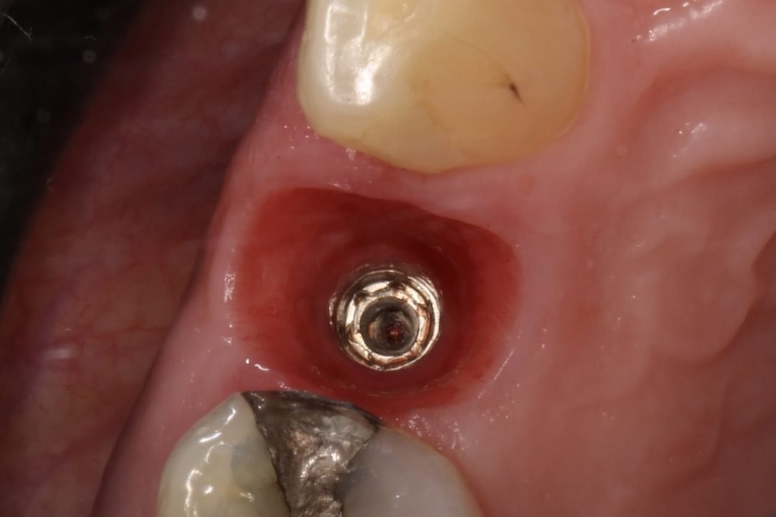 Implantin paranemisjatke lähikuvassa