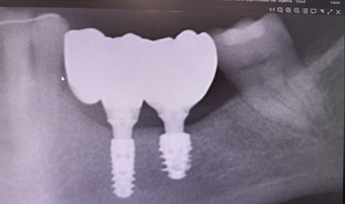 Röntgenkuva: kaksi implanttia ja implanttisilta